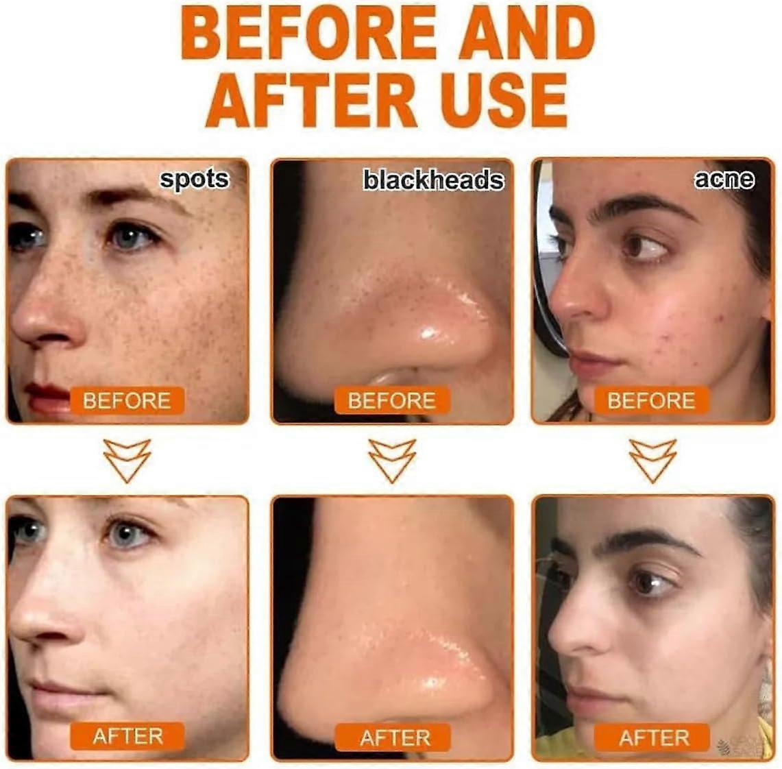 LOVILDS™ Whitening and Freckle - Removing Mask