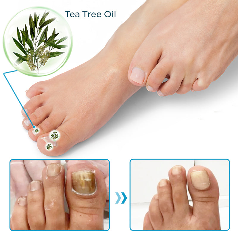 LOVILDS™ Bee Venom Deep Repair Nail Essence 🐝✨ | Powerful Antifungal & Nail Strengthening Solution 💪🌱